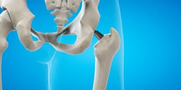 Kalça ameliyatı (1)